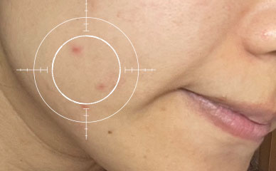 油痘肌 使用前膚況