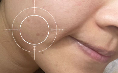 油痘肌 使用毛孔緊緻亮膚精華水後 改善膚況